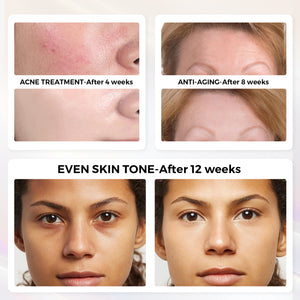 QuasarMD 3D Light Therapy Mask